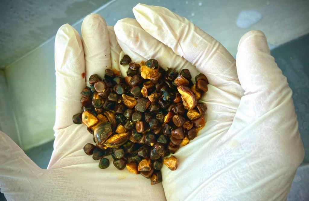 Gallstones